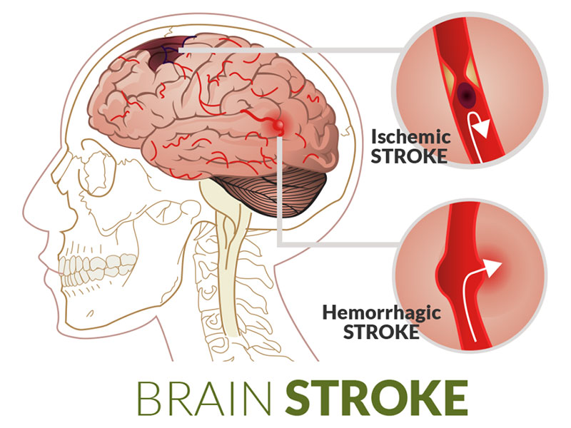 Brain Stroke Treatment