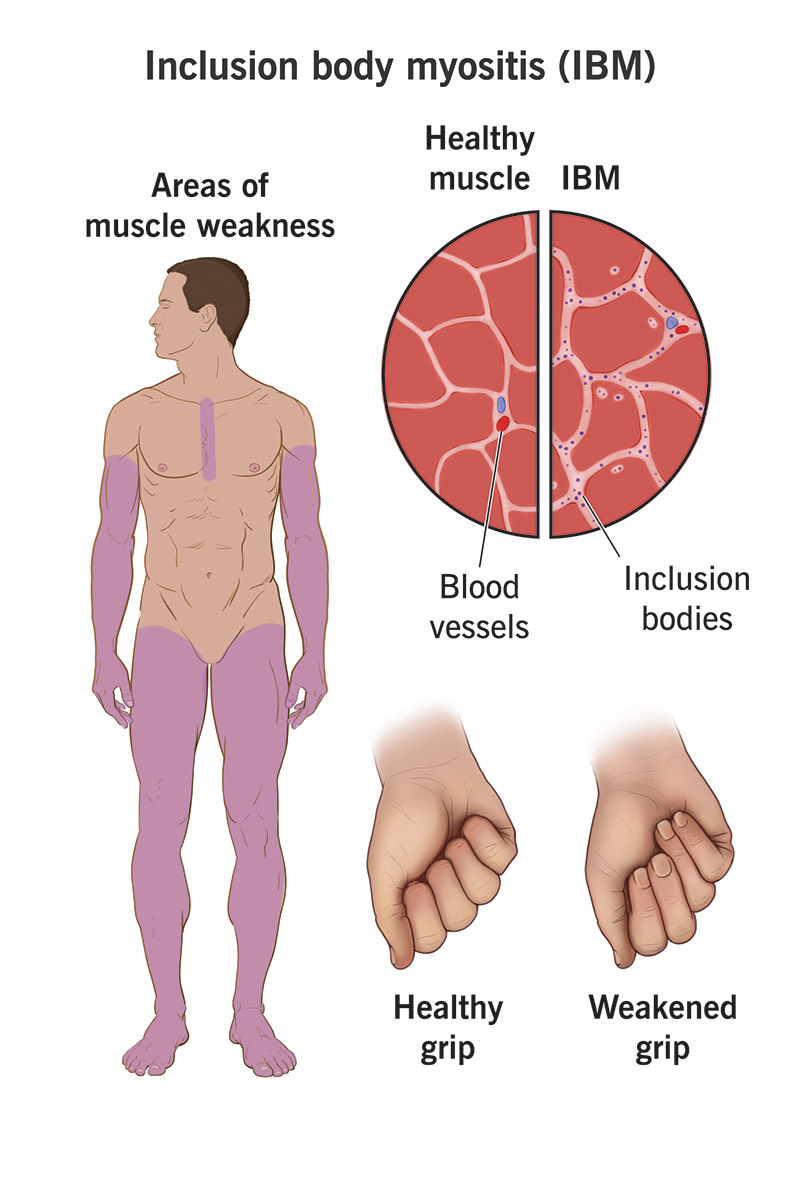 GBS & Neuropathy Care
